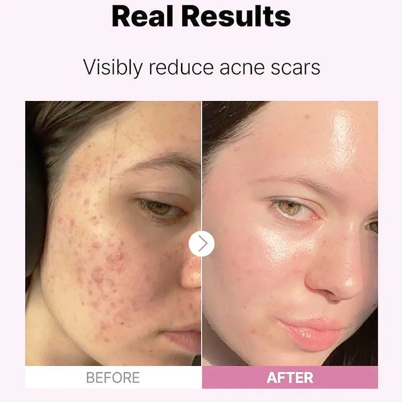 Cosrx-The-Niacinamide-15-Serum-Ορός-Υψηλής-Συγκέντρωσης-15%-σε-Νιασιναμίδη-20ml-7 Cosrx The Niacinamide 15 Serum Ορός Υψηλής Συγκέντρωσης 15% σε Νιασιναμίδη 20ml